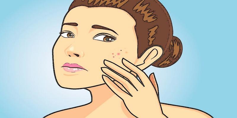 Психологический механизм развития Акне